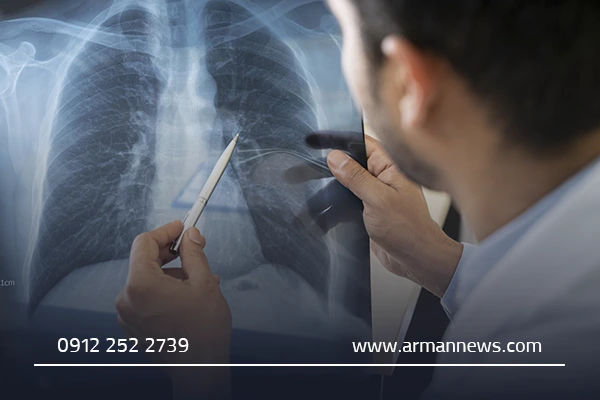 بیماری‌های شایع ریوی که نیاز به متخصص ریه دارند