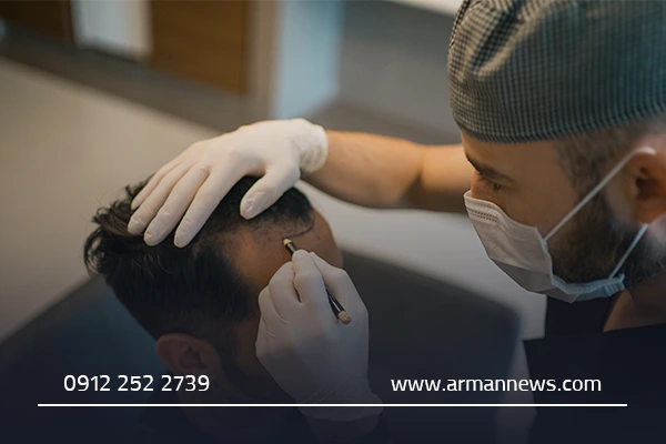 کاشت مو قم: بهترین کلینیک‌ها، روش‌ها و نکات طلایی برای داشتن موهای پرپشت