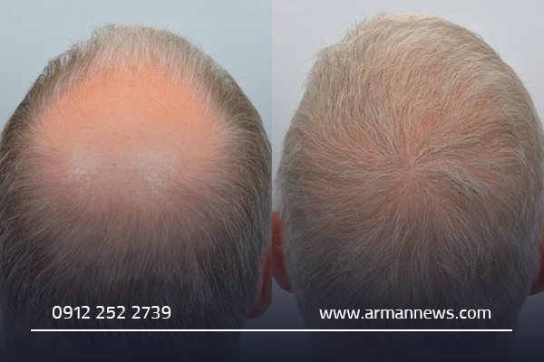 هزینه کاشت مو در قم