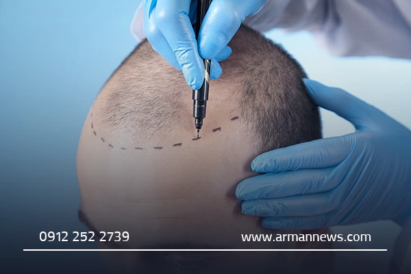 نکات مهم قبل از انجام کاشت مو قم