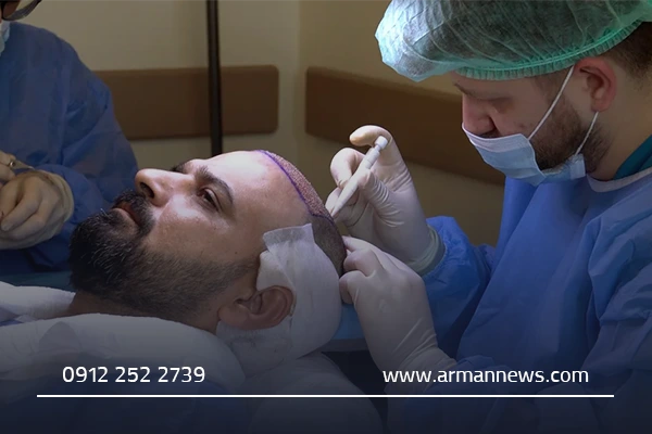 کاشت مو قم چیست و چرا محبوب است؟