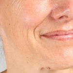 محو کردن خطوط نازولبیال (خط خنده) بدون جراحی