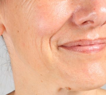 محو کردن خطوط نازولبیال (خط خنده) بدون جراحی